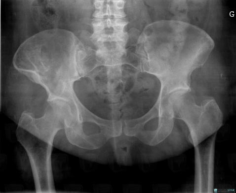 Multiple myeloma, Ilium, X rays