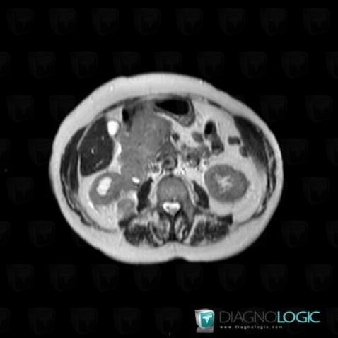 Multiple myeloma, Mesentery / Peritoneum, MRI