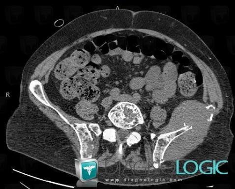 Multiple myeloma, Pelvic Muscles, CT