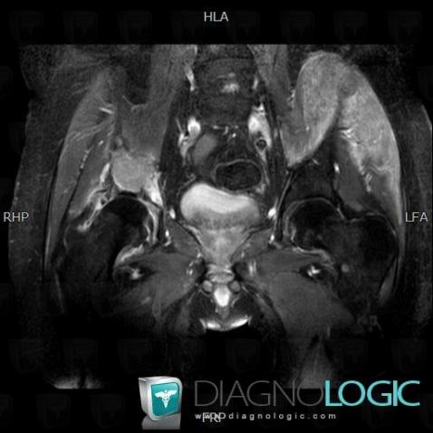 Multiple myeloma, Pelvic Muscles, MRI