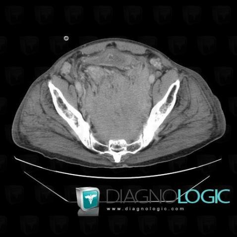 Multiple myeloma, Pelvis / Perineum, CT