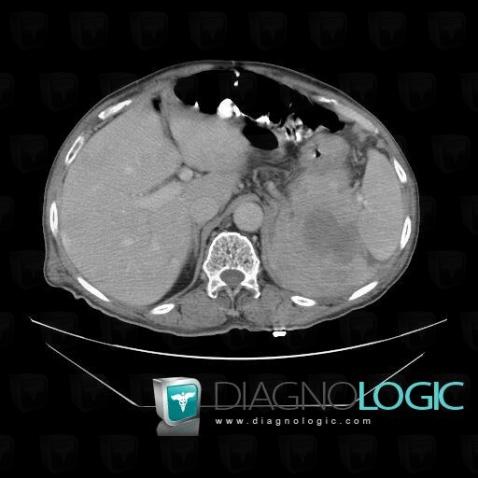 Multiple myeloma, Retroperitoneum, CT