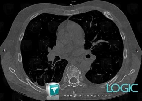 Multiple myeloma, Ribs, CT