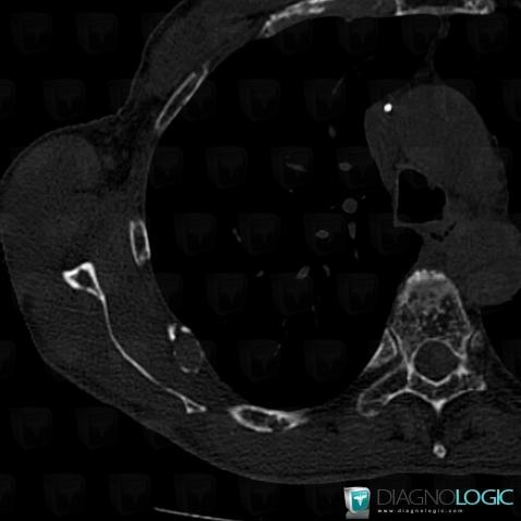 Multiple myeloma, Ribs, CT