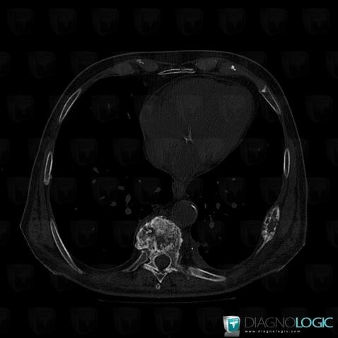 Multiple myeloma, Ribs, CT