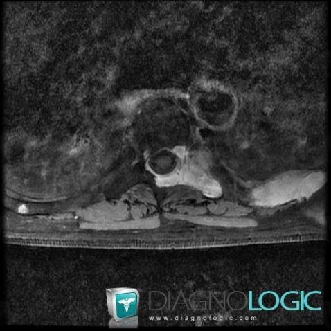 Multiple myeloma, Ribs, MRI