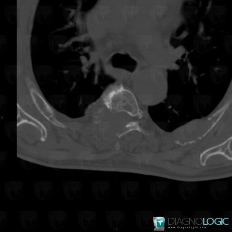 Multiple myeloma, Ribs, Vertebral body / Disk, CT