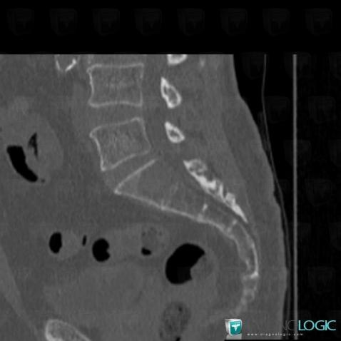 Multiple myeloma, Sacrum / Coccyx, CT