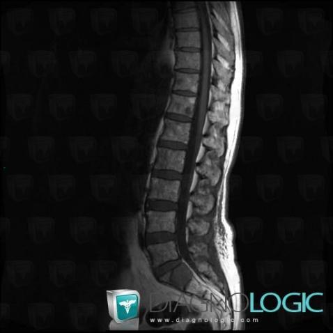 Multiple myeloma, Sacrum / Coccyx, MRI