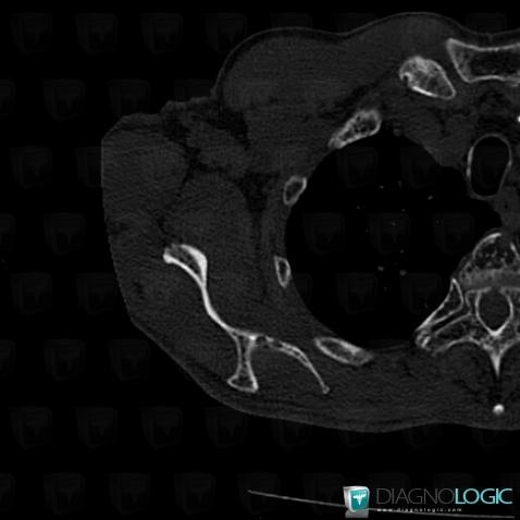 Multiple myeloma, Scapula, CT