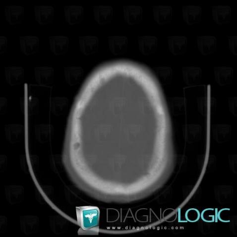 Multiple myeloma, Skull vault, CT