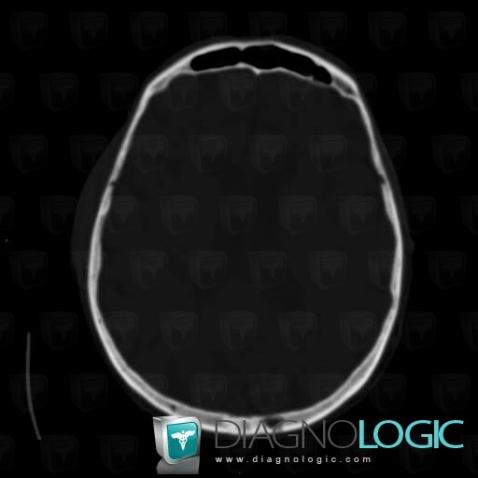 Multiple myeloma, Skull vault, CT