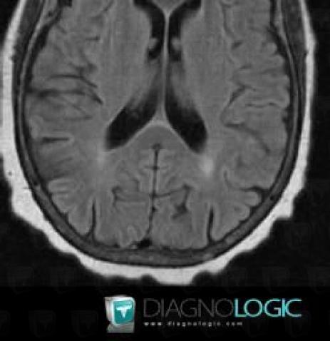 Multiple myeloma, Skull vault, MRI