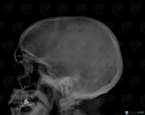 Multiple myeloma, Skull vault, X rays