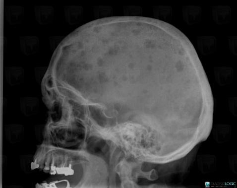 Multiple myeloma, Skull vault, X rays