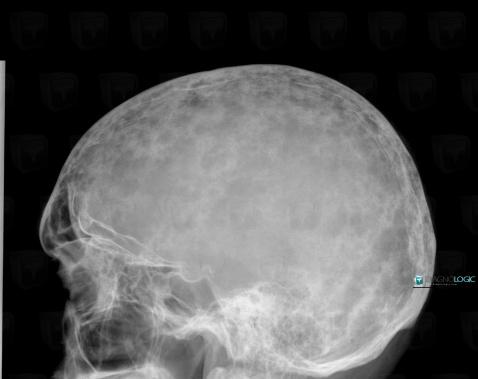 Multiple myeloma, Skull vault, X rays