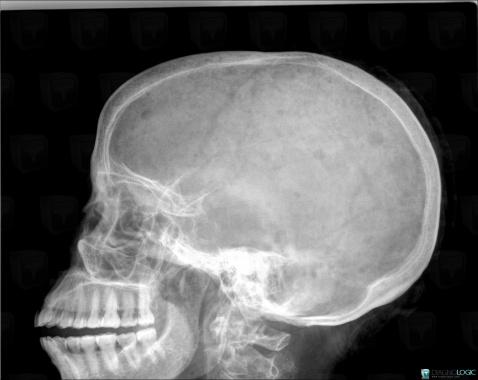 Multiple myeloma, Skull vault, X rays