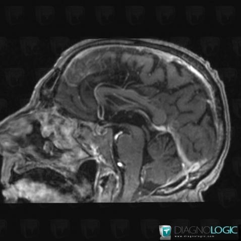 Multiple myeloma, Sphenoid bone, MRI