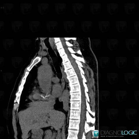 Multiple myeloma, Spinal canal / Cord, CT
