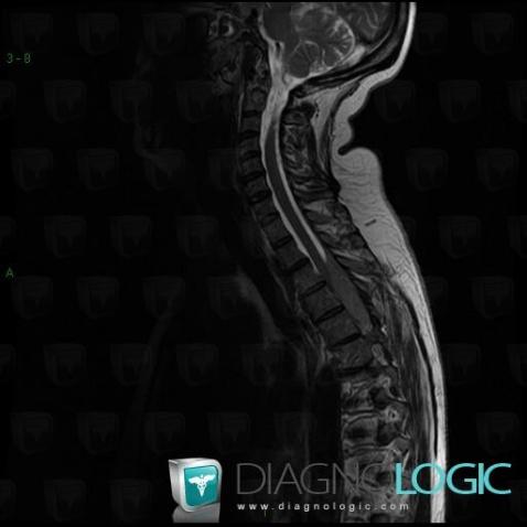 Multiple myeloma, Spinal canal / Cord, MRI