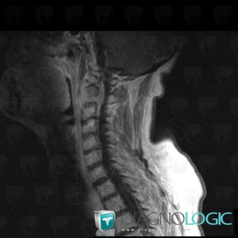 Multiple myeloma, Spinal canal / Cord, MRI