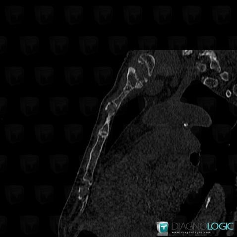 Multiple myeloma, Sternum, CT