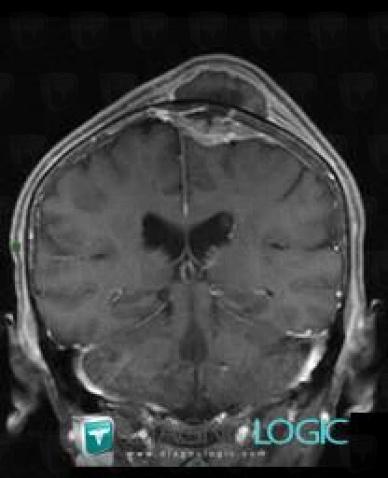 Multiple myeloma, Supratentorial peri cerebral spaces, Soft tissues - Skull, MRI