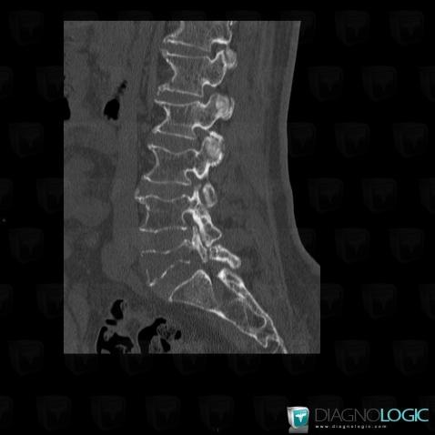 Multiple myeloma, Vertebral body / Disk, CT