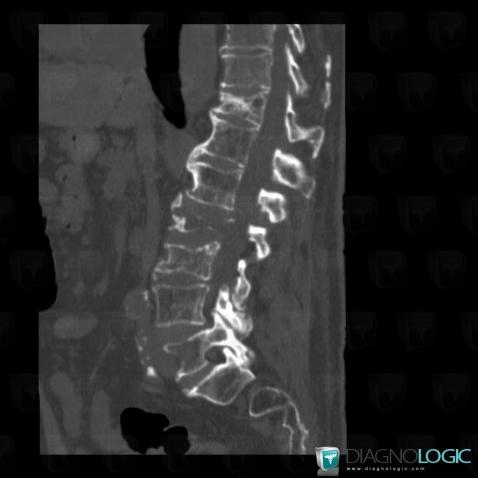 Multiple myeloma, Vertebral body / Disk, CT