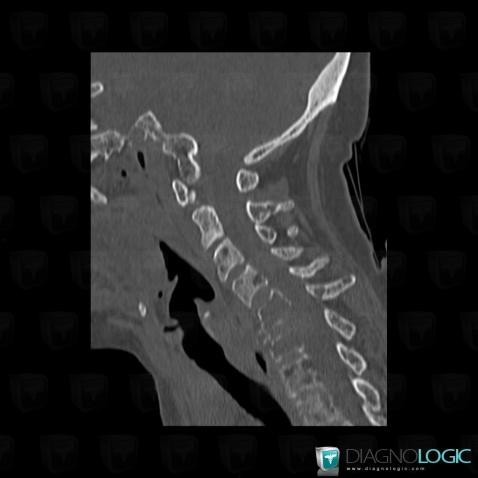 Multiple myeloma, Vertebral body / Disk, CT