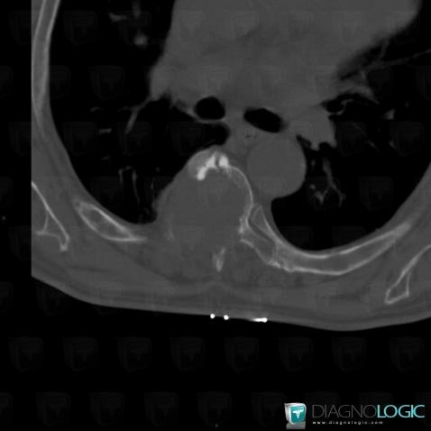 Multiple myeloma, Vertebral body / Disk, CT