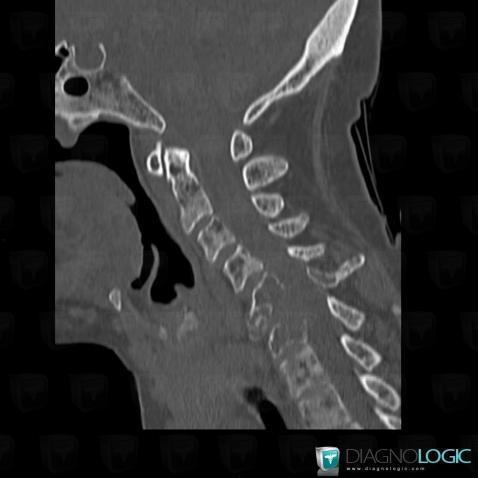 Multiple myeloma, Vertebral body / Disk, CT