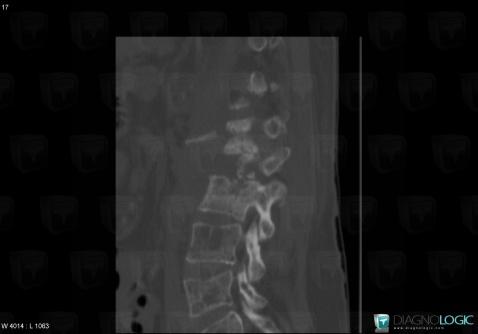 Radiology case : Multiple myeloma (CT) - Diagnologic