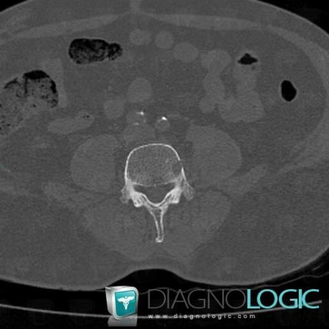 Multiple myeloma, Vertebral body / Disk, CT