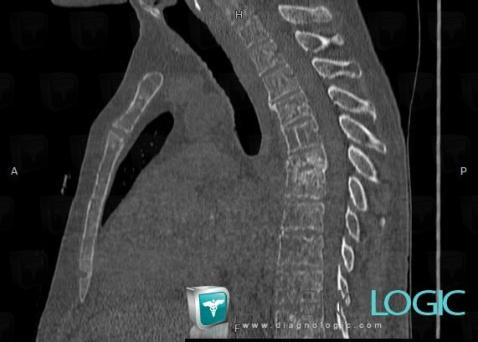 Multiple myeloma, Vertebral body / Disk, CT