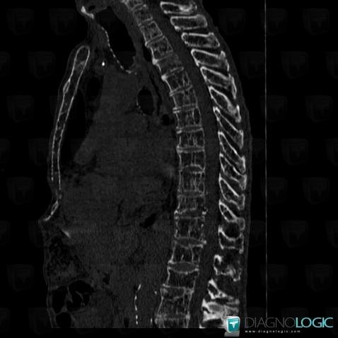Multiple myeloma, Vertebral body / Disk, CT