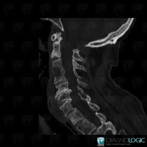 Radiology Case Multiple Myeloma CT MRI Diagnologic