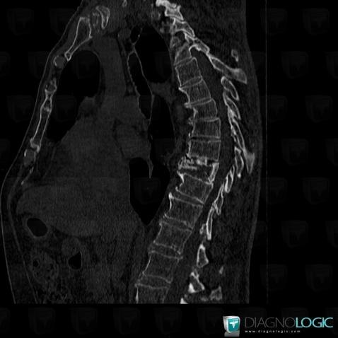 Multiple myeloma, Vertebral body / Disk, CT