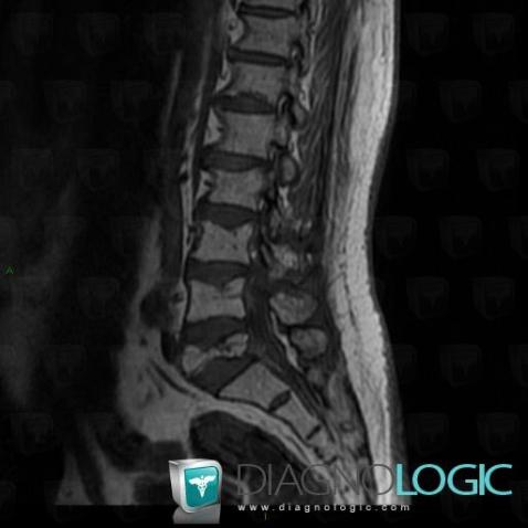 Multiple myeloma, Vertebral body / Disk, MRI