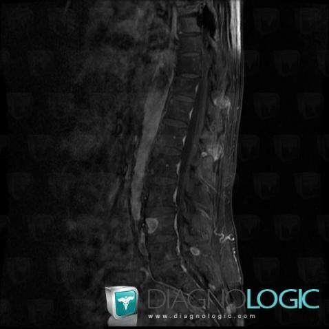 Multiple myeloma, Vertebral body / Disk, MRI