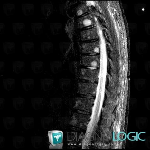 Multiple myeloma, Vertebral body / Disk, MRI