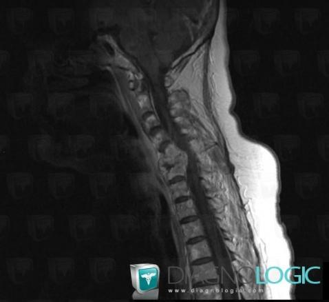 Multiple myeloma, Vertebral body / Disk, MRI