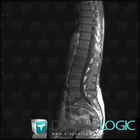 Multiple myeloma, Vertebral body / Disk, MRI