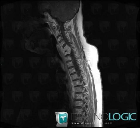 Multiple myeloma, Vertebral body / Disk, MRI