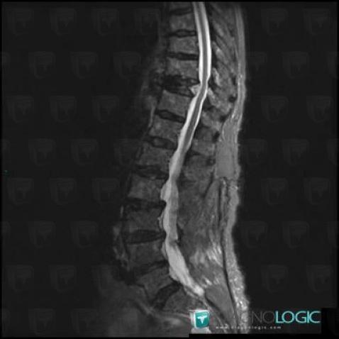 Multiple myeloma, Vertebral body / Disk, MRI