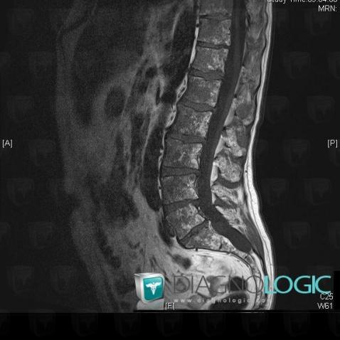 Multiple myeloma, Vertebral body / Disk, MRI