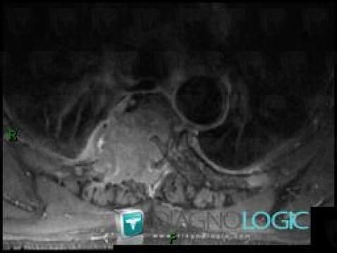 Multiple myeloma, Vertebral body / Disk, Spinal canal / Cord, MRI