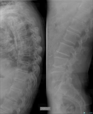 Multiple myeloma, Vertebral body / Disk, X rays