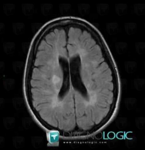 Multiple sclerosis, Basal ganglia and capsule, Ventricles / Periventricular region, MRI