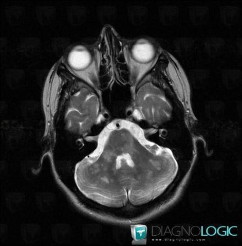 Multiple sclerosis, Brainstem, Cerebellar hemisphere, MRI